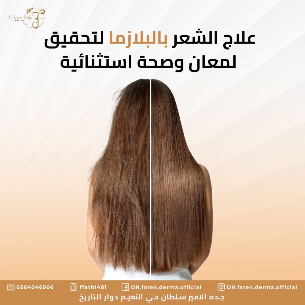 علاج الشعر بالبلازما لتحقيق لمعان وصحة استثنائية